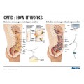 Small- CAPD : HOW IT WORKS Paper Laminated Poster (English) Small- CAPD : HOW IT WORKS Paper Laminated Poster (English)